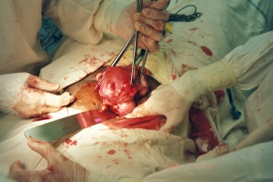 Multiple fibroids distorting the uterus